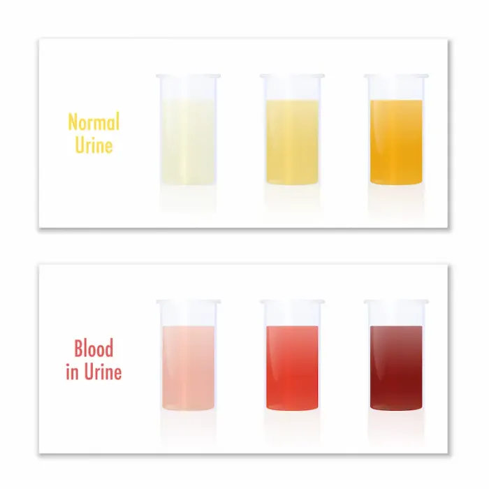 Blood in Urine; 12 Potential Causes and What to Do Next